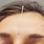 Acupuncture